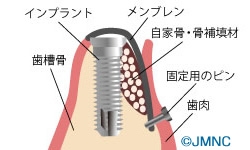 GBR（骨再生誘導法）